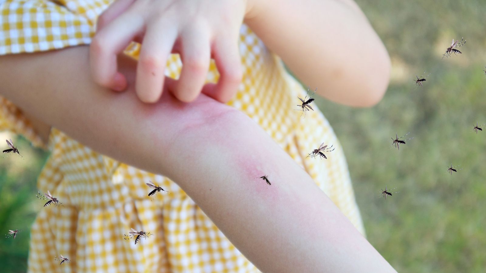 Illustration d'une allergie aux piqûres de moustiques. ©©Kwangmoozaa, Adobe Stock